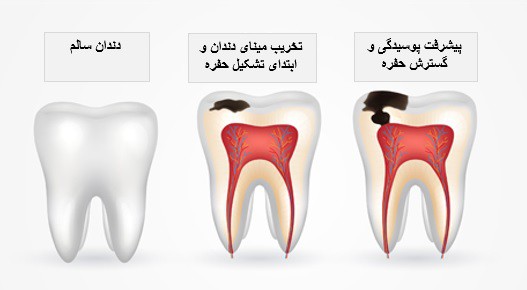 پوسیدگی دندان 